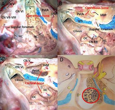 Invasive Corridor of Clivus Extension in Pituitary Adenoma: Bony Anatomic Consideration, Surgical Outcome and Technical Nuances